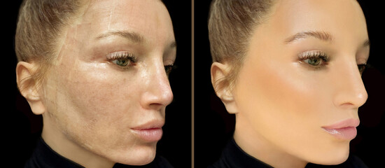 Fototapeta premium CO2 laser treatment ,Cosmetic Laser Dermatology 