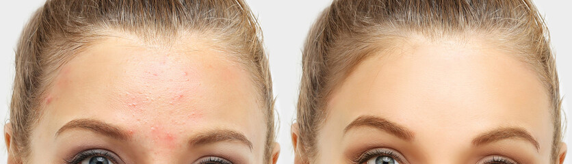 Obraz premium Post-Acne Marks .Treating Acne Scars.Acne Scar Removal