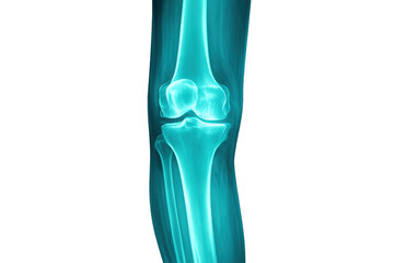 Human knee x-ray showing bones and joint structure, representing orthopedic medicine and skeletal health on transparent background