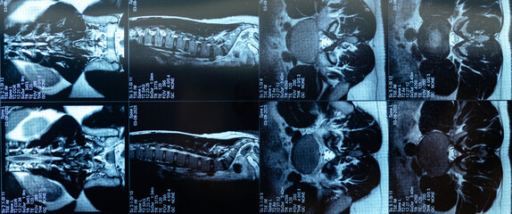 Detailed mri scan reveals spinal protrusion and vertebrae structure