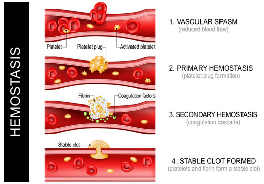 Hemostasis. Wound healing. Platelets and fibrin form a stable clot.