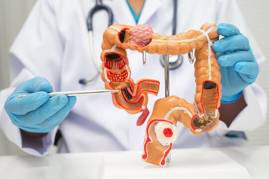 Colorectal cancer, doctor holding intestine colon human model.
