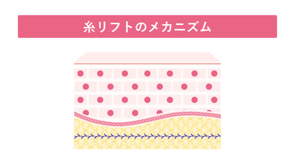 糸リフトのメカニズム