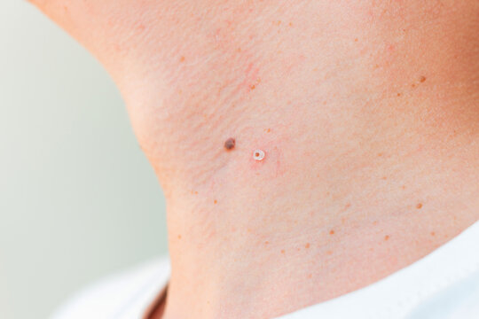 A man's neck with skin growths, including papillomas. One papilloma is tied with a small rubber band, a common removal method.