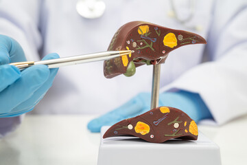 Cirrhosis, Liver cancer, fatty liver, Asian doctor with liver human model.