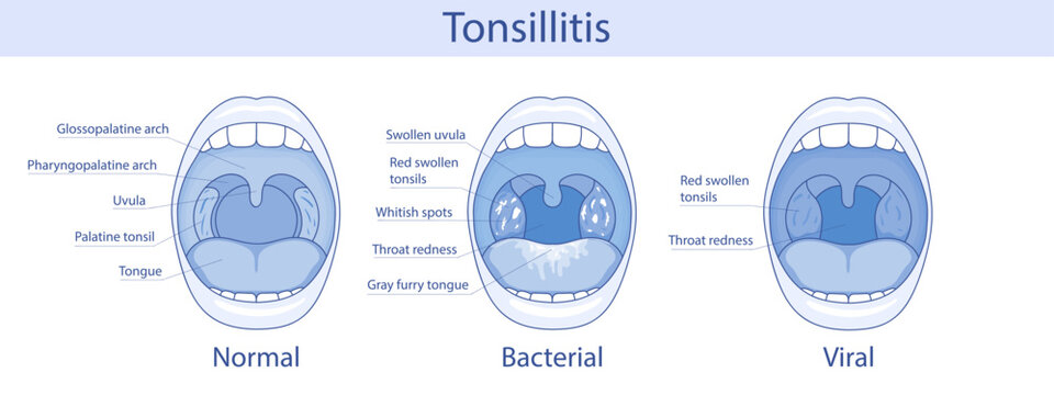 Medical anatomical illustration. Tonsillitis can be bacterial or viral in nature. Infection of the tonsils. Open mouth, anatomy.