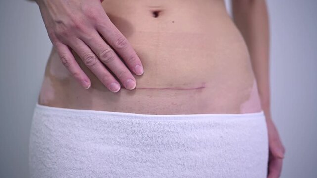 Female patient's abdomen with vitiligo shown up close, her hands gently touching and stroking the caesarean section scar, symbolizing body acceptance and the healing journey after surgery