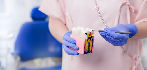 Female dentist demonstrating tooth anatomy model with caries and nerve canal problems in dental office