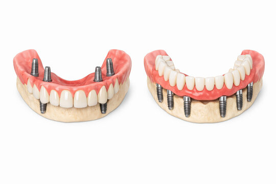 Dental implant supported dentures models showing upper and lower prosthetic teeth with metal posts isolated on white background for dentistry education oral surgery and restorative treatment planning