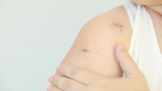 Close-up of a female shoulder with healing surgical sutures and scars after joint surgery, medical stitches on skin, Successful post-operative recovery and orthopedic healthcare concept, trauma care