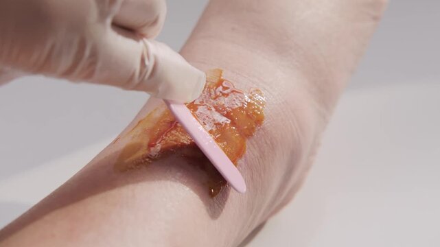 Doctor applying healing ointment to recovering wound on woman leg, treating female ankle, medical treatment skin injury, healthcare support and recovery rehabilitation, patient care, injury healing