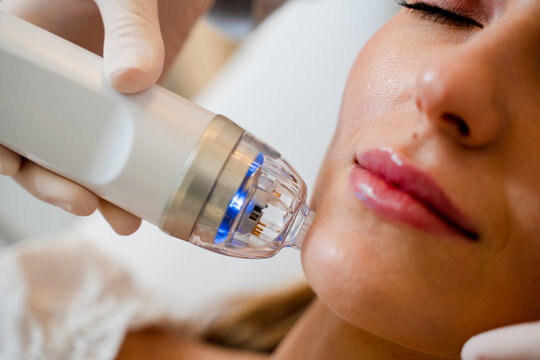 Needle fractional RF facelift procedure in professional medical cosmetology clinic.
