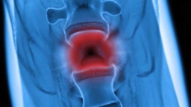 Spine Xray Showing Herniated Disc.