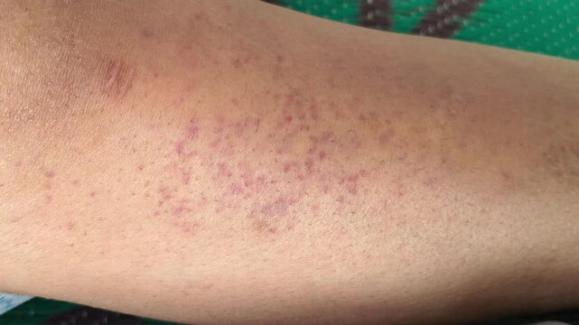 Close up of red skin rash or petechiae on human leg with small purple spots