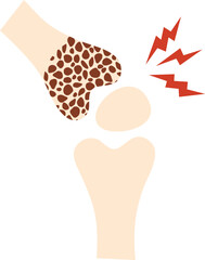 Osteoporosis Illustration
