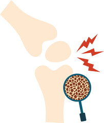 Osteoporosis Illustration