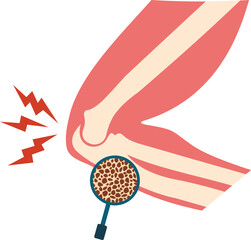 Osteoporosis Illustration