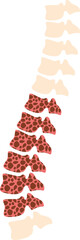 Osteoporosis Illustration