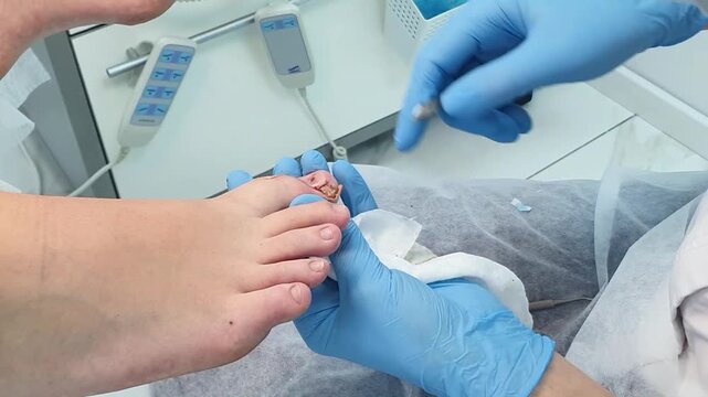 A doctor treats the wound and removes excess skin from the patient's ingrown toenail at an orthopedic clinic.
