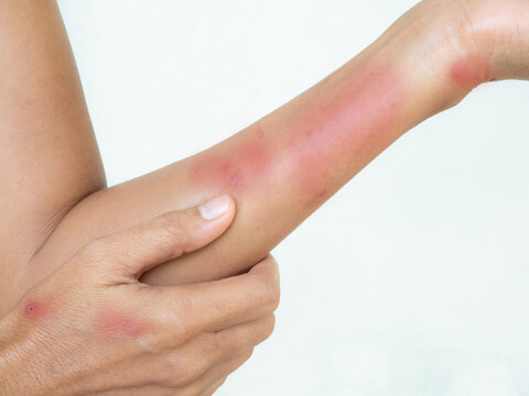 Hand with urticaria allergy itchy rash eczema itch woman from food,grass,air poisoning,cosmetic,health,body care disease lilness air,dissease medicine calamine Lotion Treatment ,infection pain scratch