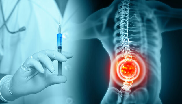3d illustration of a lumbar spine injection, cancer treatment