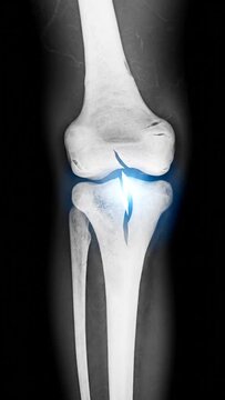 Knee Joint X Ray Medical Imaging Video.
