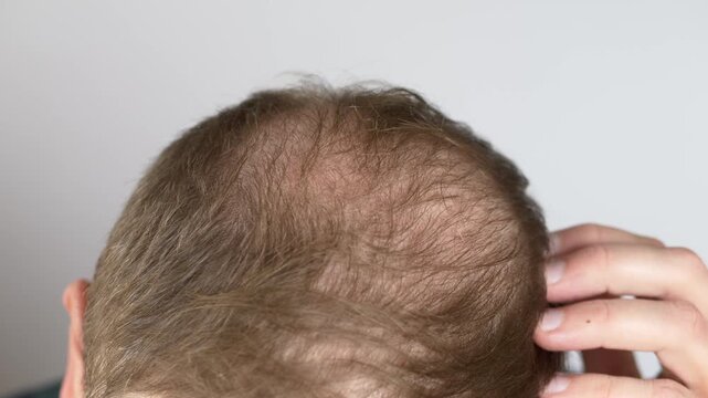 Close up view of thinning hair on scalp crown. Male pattern hair loss concept showing early alopecia stage. Medical and cosmetic background for hair transplant, trichology, anti baldness treatment.