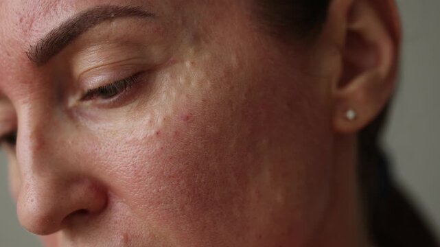 Injection marks on the face of a woman after biorevitalization treatment. 4K