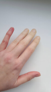 Raynaud's phenomenon on female hand. Close up of white, bloodless fingers caused by vasospasm. Medical condition and circulatory disorder concept.