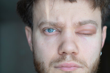 A man with an eye allergy, angioedema, swelling