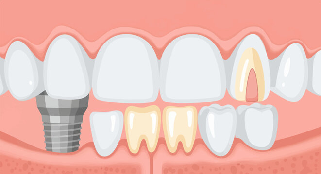 Close-up illustration of teeth showing a dental implant and a damaged tooth