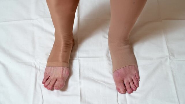 Lymphedema swelling foot wearing compression stocking medical care leg