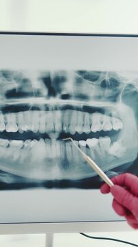 The dentist examines a panoramic x-ray of the teeth. The dentist shows the problem teeth on the X-ray of the teeth with his finger.