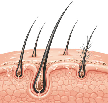 Create a realistic Oily Scalp and Clogged Follicles Causing Weak Hair. vector art with white background..
