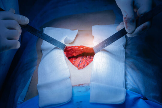 Surgical procedure: close-up of an abdominal surgery with medical instruments, medical mesh after umbilical hernia removal