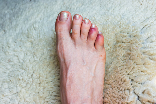 Close up of a bare foot with a broken or sprained bruised reddened fourth and fifth toes distal and middle phalange