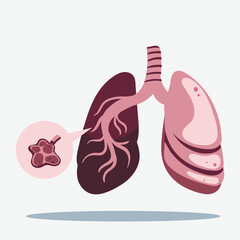 Illustration of human lungs with a magnified view of a damaged alveolus, representing respiratory disease.