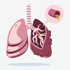 Illustration of human lungs, with one healthy lung and the other showing an internal view of inflamed bronchioles with mucus, depicting a respiratory illness.