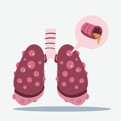 Illustration of diseased lungs with growths and an inflamed bronchiole expelling mucus.