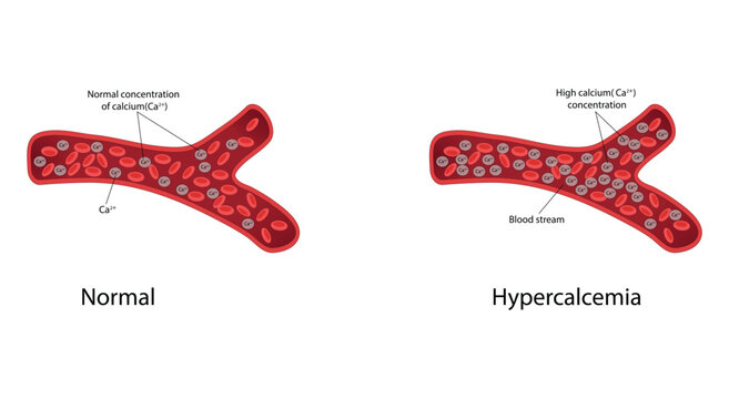 Hypercalcemia vector illustration