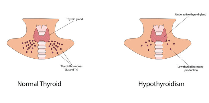 Hypothyroidism vector illustration