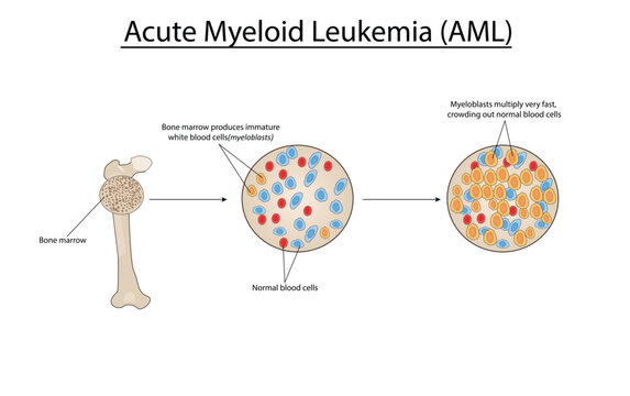 Acute myeloid leukemia (AML) vector illustration