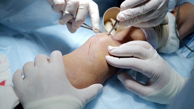 Russia Tomsk 05.07.2025: Surgeon suturing incision on foot dorsum with precise needlework, gloved hands guide suture thread while assistants manage instruments and suction, controlled
