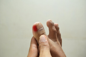 Ingrown toenails on man's foot, pain in the big toe. Health problems concept