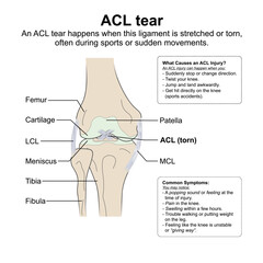 ACL tear, Knee ligament torn Flashcard