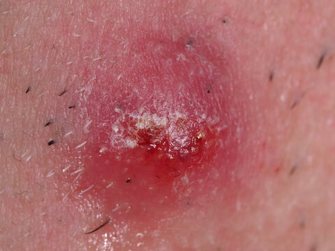 A red, purulent pimple on a man's neck