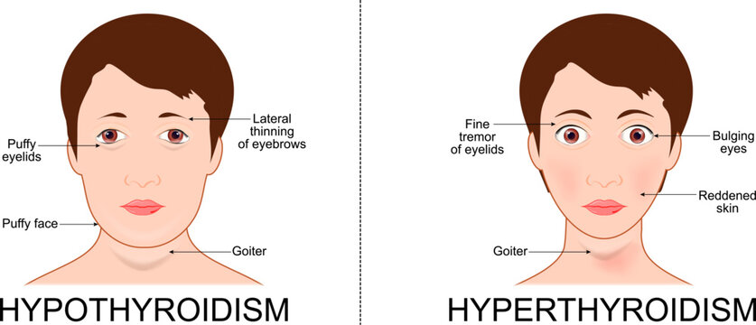 Hyperthyroidism and Hypothyroidism. Signs and symptoms of endocrine disease. Thyroid disorders.
