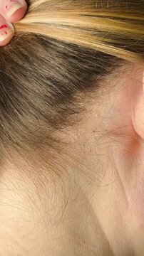 Seborrheic dermatitis on a woman's scalp close-up. Treatment of dandruff on the hair. Dermatological diseases. Trichology