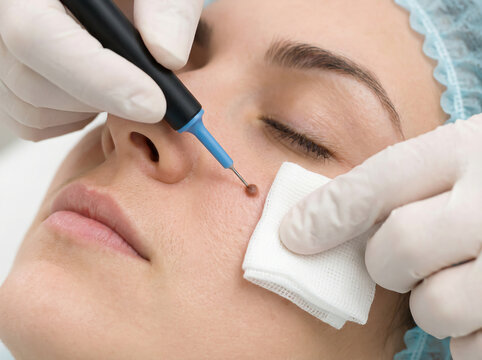 Dermatologist removing facial mole from young woman cheek using electrocautery pen during cosmetic skin procedure in clinic