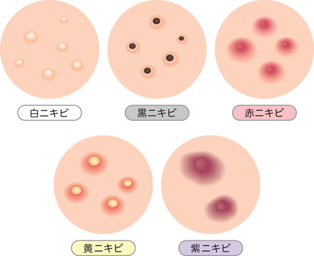 ニキビ種類　5種セット
